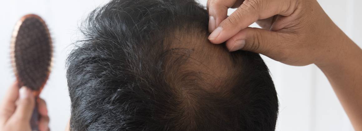 Hvad er årsagen til tyndt hår og hårtab?