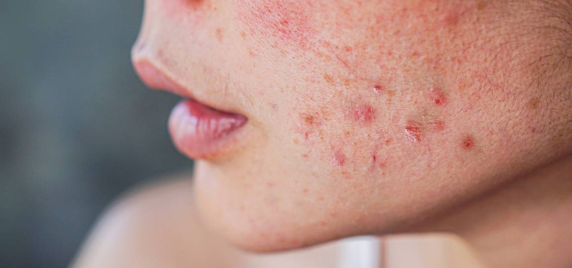 Hvordan slipper dermatologer af med akne?