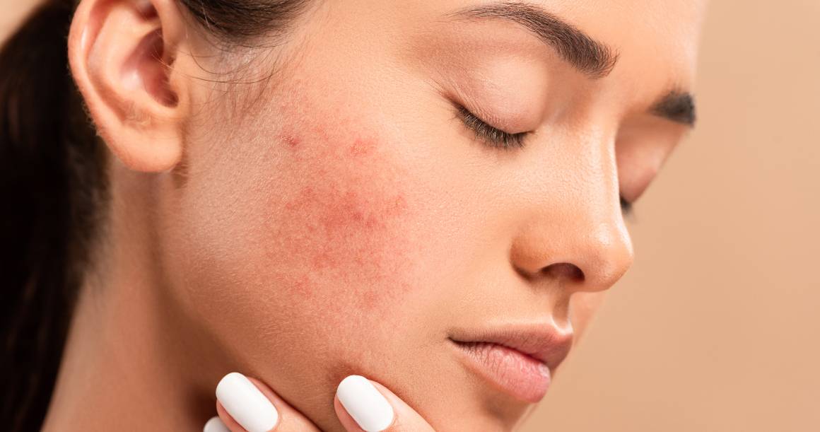 Hvad dræber acne-bakterier?