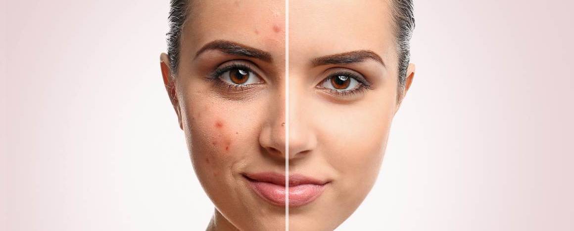 Bliver akne værre af at vaske dit ansigt?